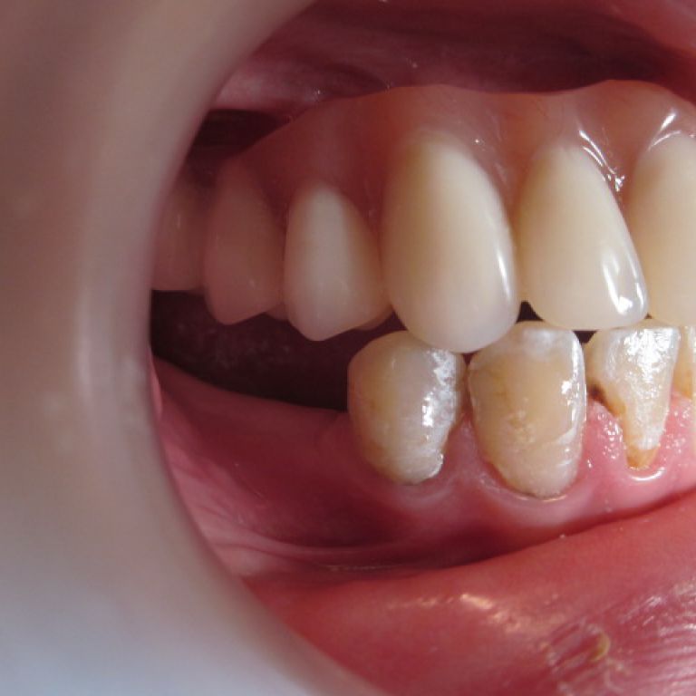 Po leczeniu ortodontyczno-protetyczno-implantologicznym