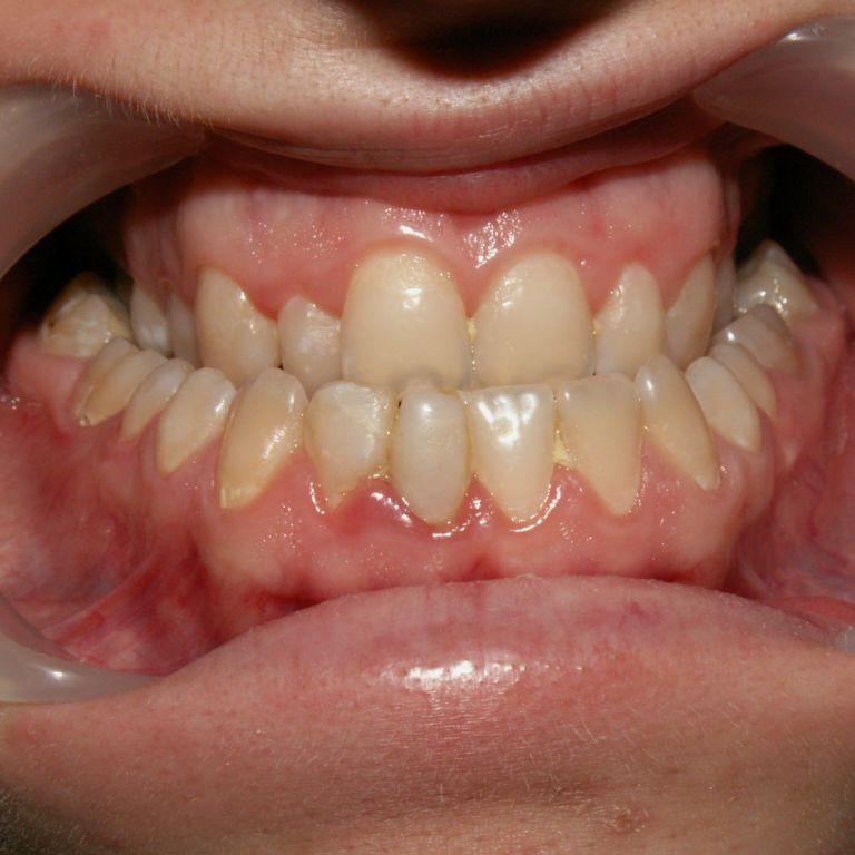 Przed leczeniem ortodontyczno-chirurgicznym