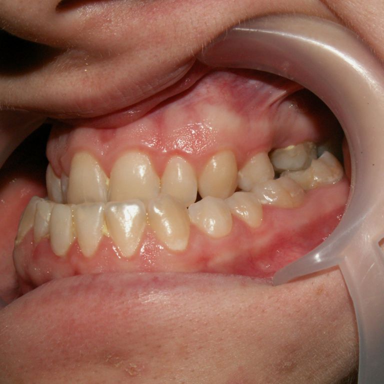 Przed leczeniem ortodontyczno-chirurgicznym