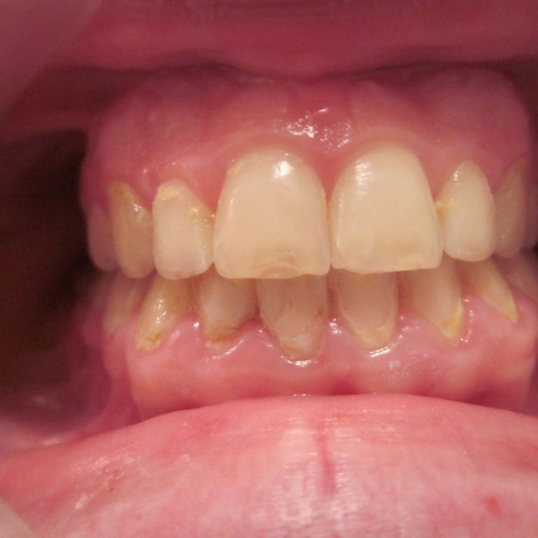 Po leczeniu ortodontyczno-chirurgicznym