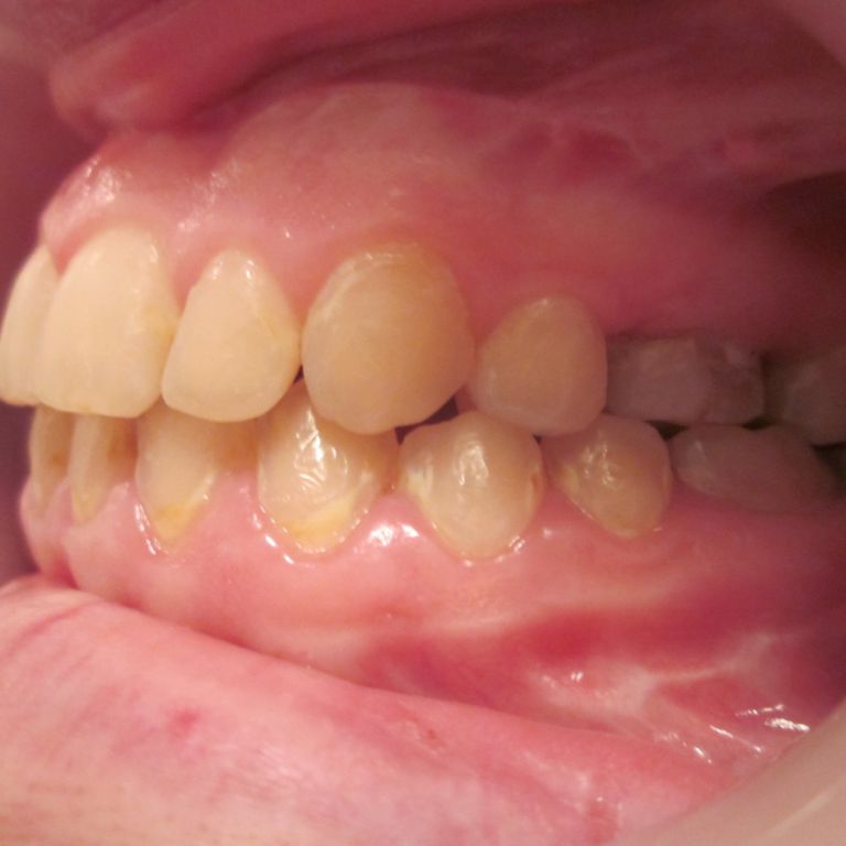 Po leczeniu ortodontyczno-chirurgicznym