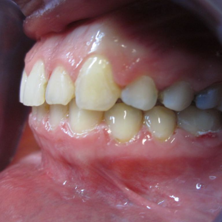 Po leczeniu ortodontycznym