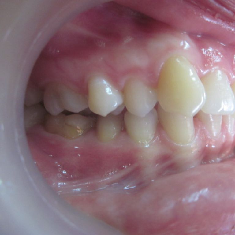 Przed leczeniem ortodontycznym