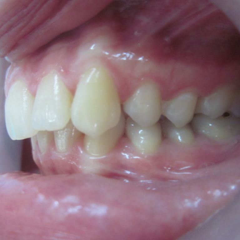 Przed leczeniem ortodontycznym
